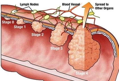 colon cancer stage