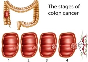 colon cancer stages | Anatomy System - Human Body Anatomy diagram and ...