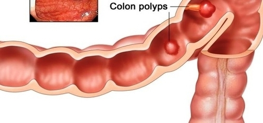 colon cancer stages early detection