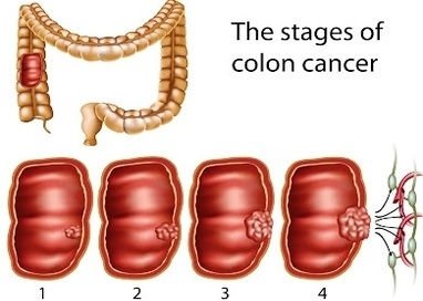colon cancer stages