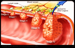 colorectal cancer colorectal cancer stages