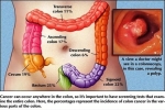 colorectal cancer lg