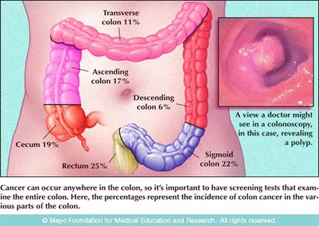 colorectal cancer lg