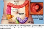 colorectal cancer lg1