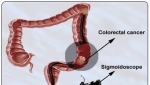 colorectal cancer screening