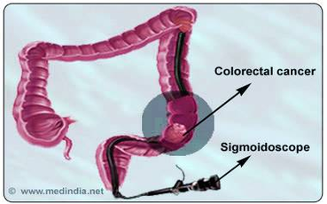 colorectal cancer screening