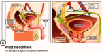 confined prostate cancer