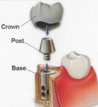 corvallis dental implants