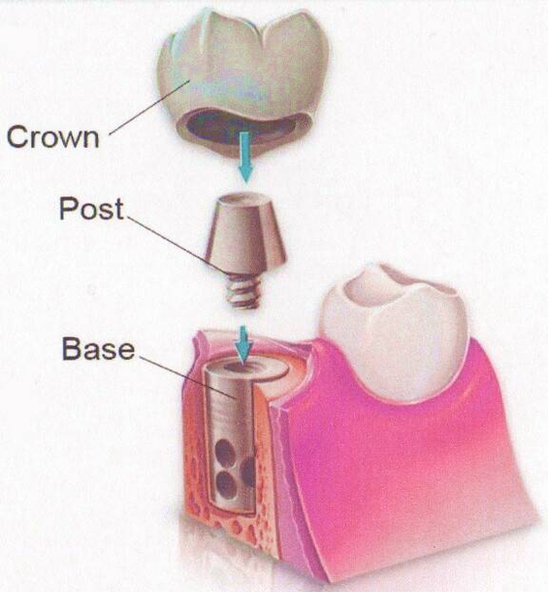 corvallis dental implants figure