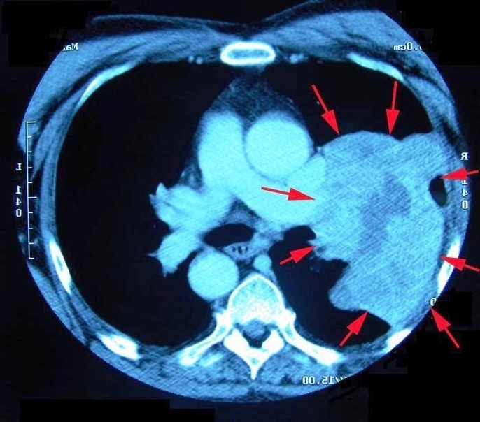 ct scan lung cancer