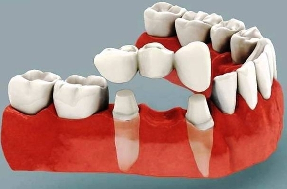 dental bridges costa rica