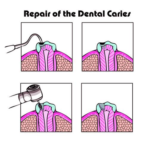 dental cavity repair photo