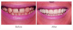 Dental crown before after | Anatomy System - Human Body Anatomy diagram ...