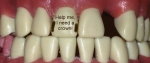 dental crown tooth before