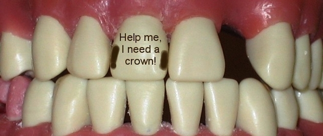 dental crown tooth before
