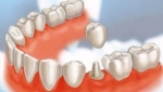 dental crowns lake county il