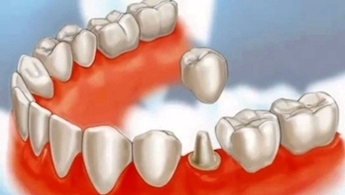dental crowns lake county il1