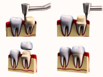 dental crowns procedure