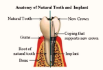 dental implant