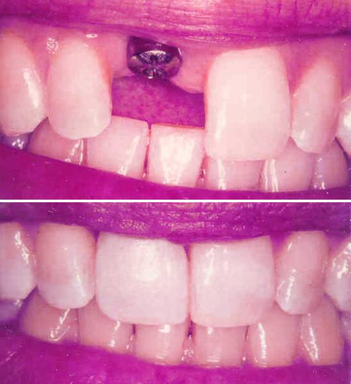 dental implant before and afters