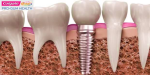 dental implant colgate diagram