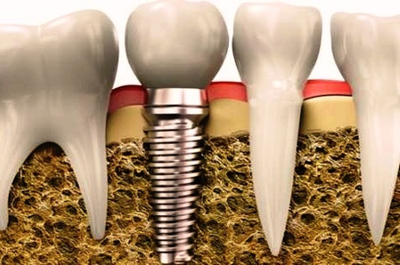 dental implant colgate