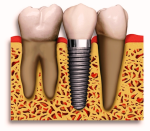 dental implant teeth std