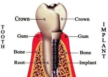dental implants gilbert az