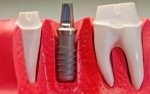 dental implants mesa