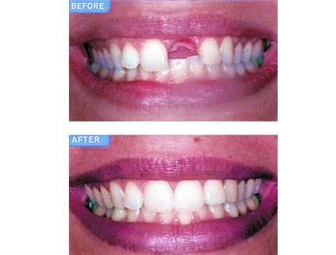 dental implants photo