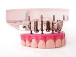 dental implants success your shape blogs