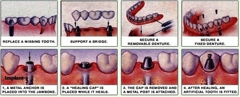 dental implanttures