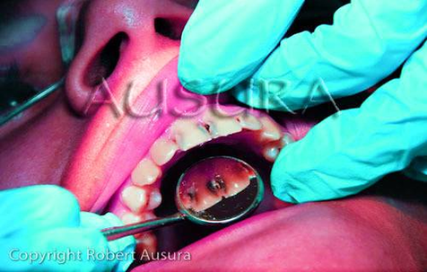 dental restoration id figure