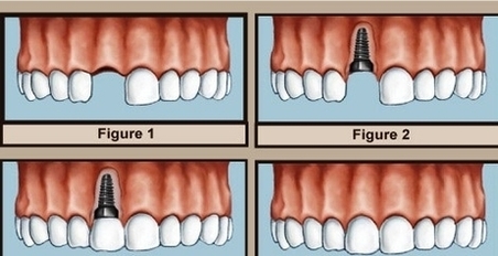dentalimplantsdental