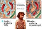 diabetes mellitus in children