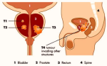 diagnosis grading staging