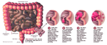 diagram colon cancer stages