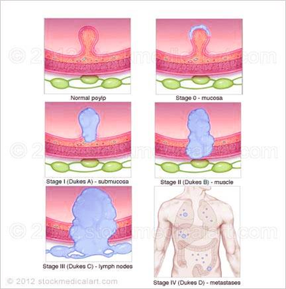 diagram colon cancer staging