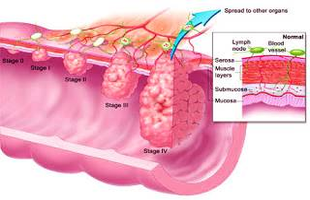 diagram colon cancer