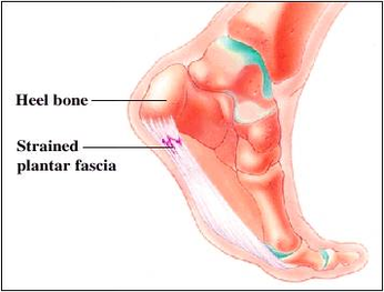 diagram easy plantar fasciitis stretches foot