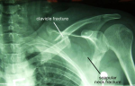 diagram floating shoulder xray