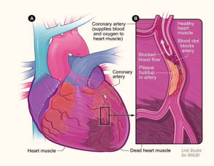 diagram heart attack large | Anatomy System - Human Body Anatomy ...