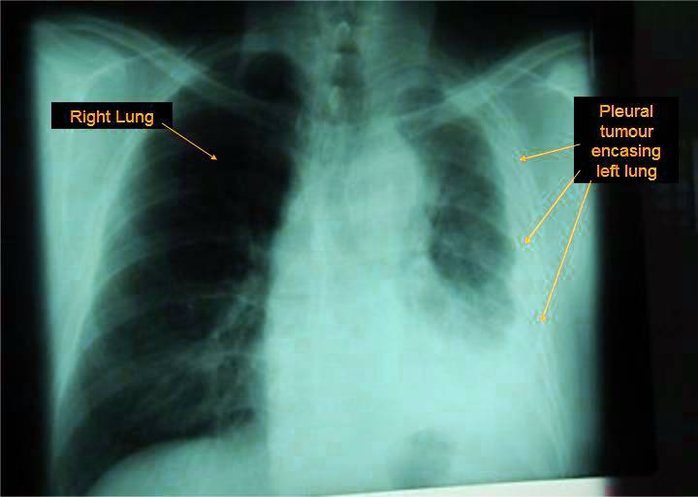 diagram lung mesothelioma