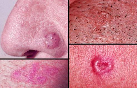 diagram of collage of basal cell carcinoma