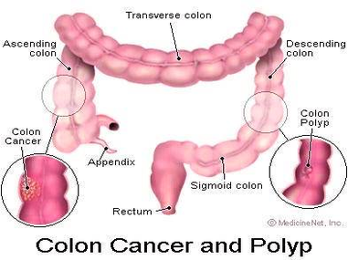 diagram of colon cancer and polyp