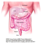 diagram of cystic fibrosis patients need early colon cancer screening