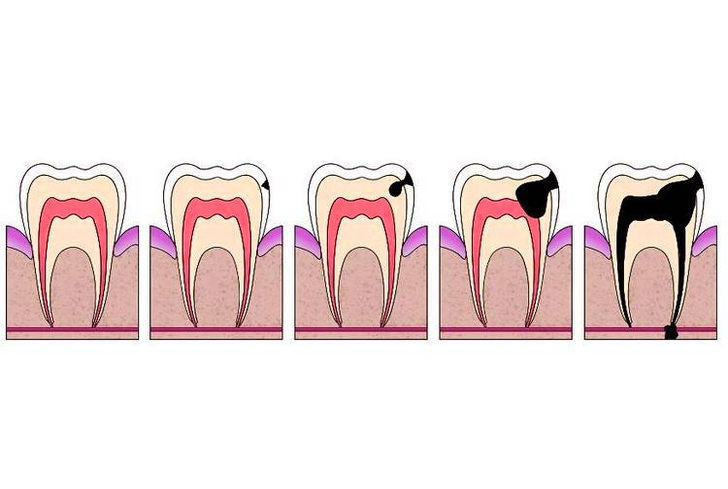 diagram of dental cavity