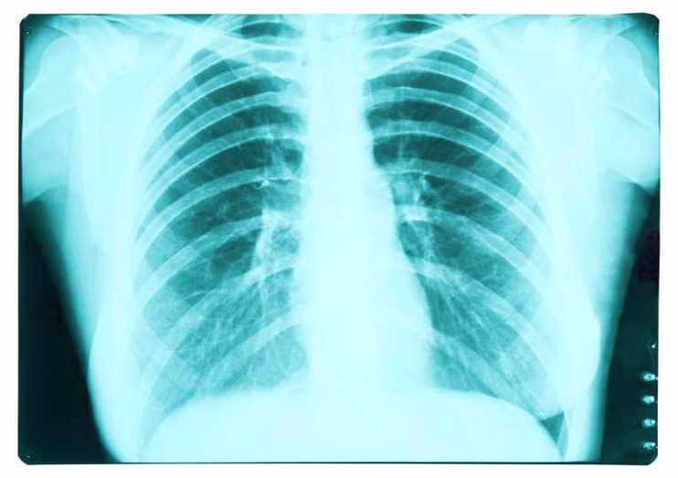 diagram of early detection copd could help prevent lung cancer