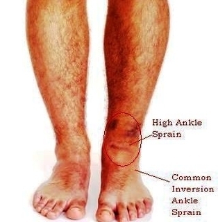 diagram of high ankle sprain