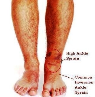 diagram of high ankle sprain